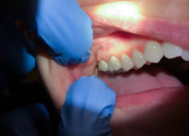 Best Chipped Tooth Repair Near Me  in K I Sawyer, MI